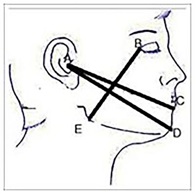 Efficacy of Submucosal Injection of Chymotrypsin, Oral Serratiopeptidase or Oral Dexamethasone in Reducing Postoperative Complications Following Impacted Lower Third Molar Surgery: A Prospective, Randomized, Double-Blind, Controlled Clinical Trial